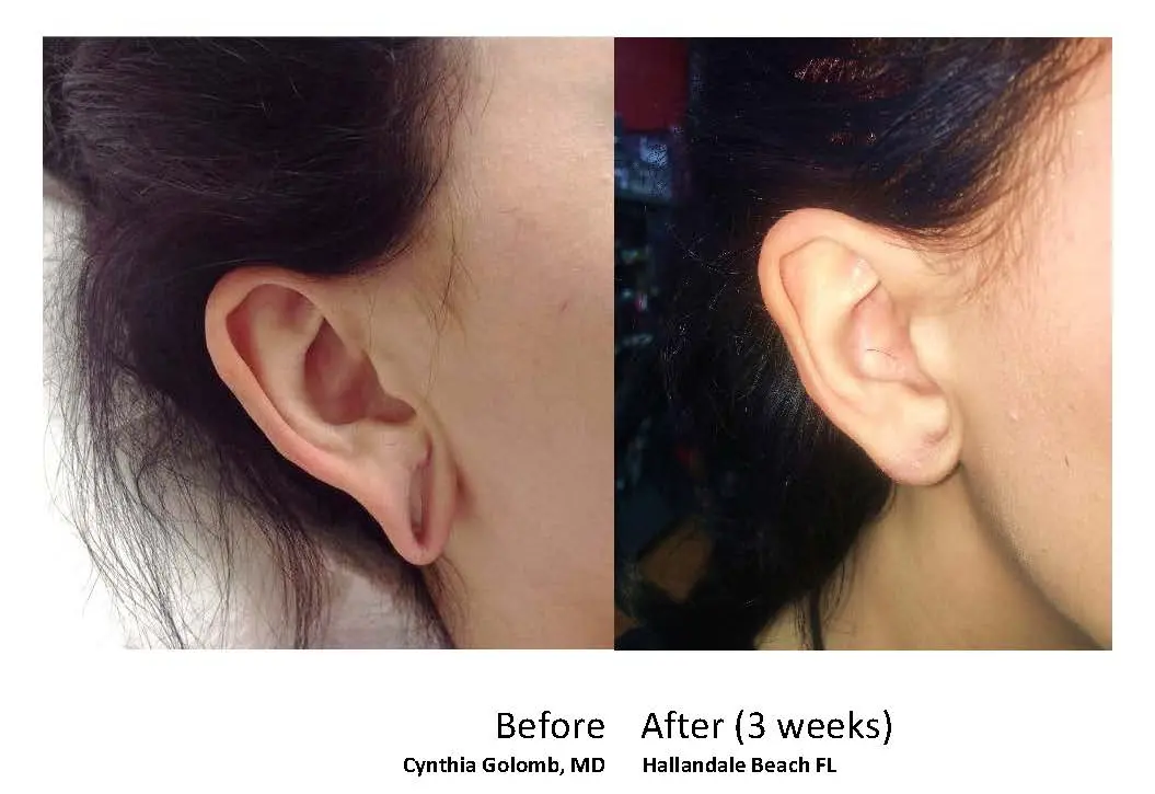 Gauge Earring Earlobe Repair Dr. Cynthia Golomb M.D