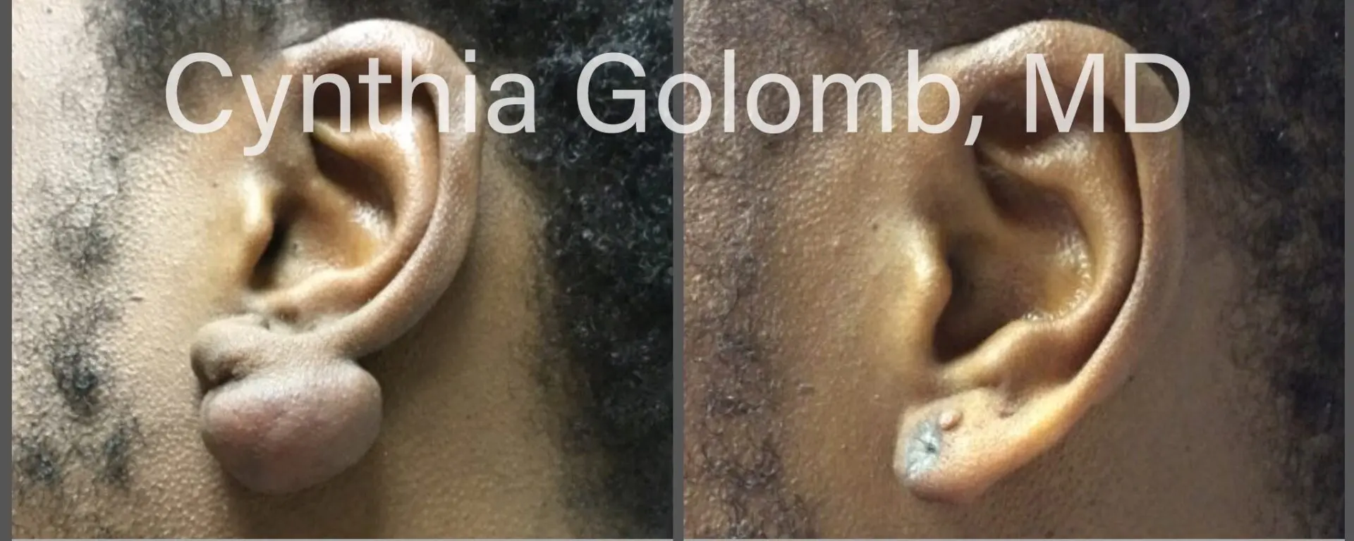 Keloid Post-Operative Pressure Earrings