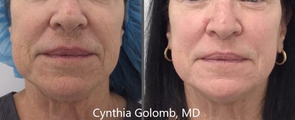 a woman's face before and after CoolPeel CO2 Laser skin Resurfacing