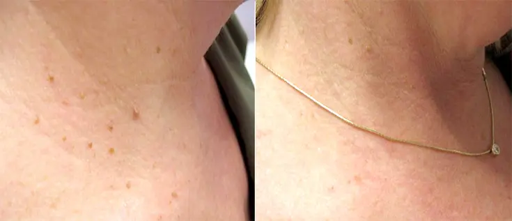 Skin Tag Removal | Cynthia Golomb, MD | Dermatology Boutique