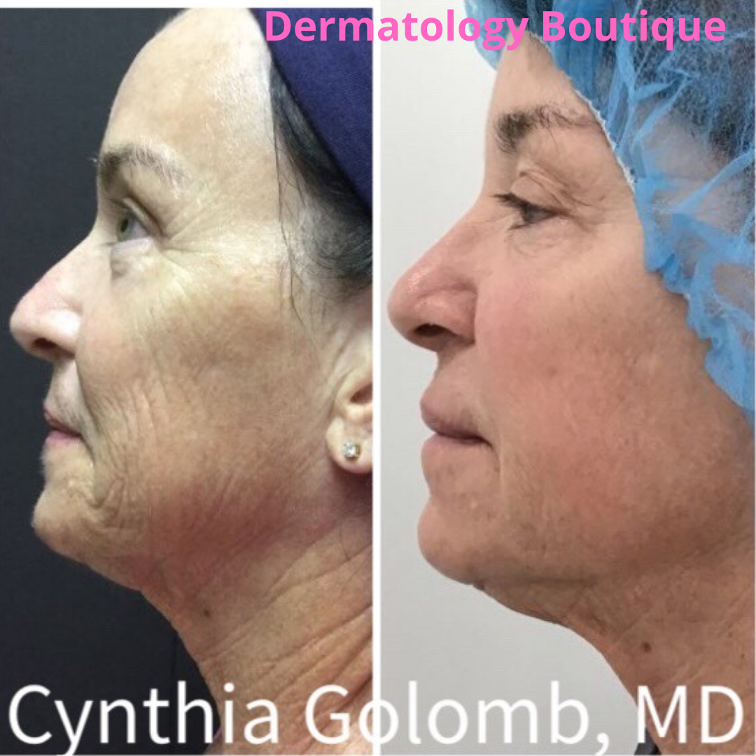 Fraxel Laser vs CO2 Laser Cynthia Golomb, MD Dermatology Boutique