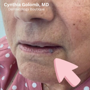 Photo of a patient with venous lake on her lip