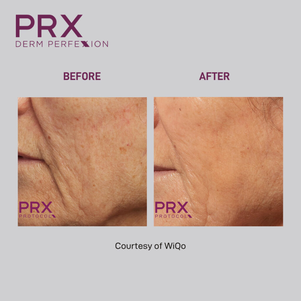 Before and after PRX Derm Perfexion treatments. Marionette lines improved