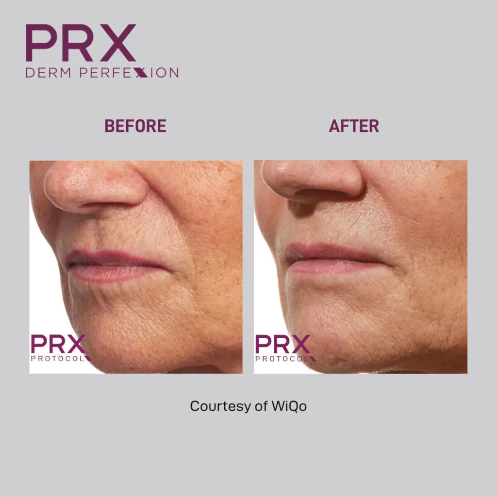 Before and after PRX Derm Perfexion treatments. Lines around the mouth improved.
