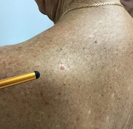 Basal Cell Carcinoma on a man's back, near his shoulder.