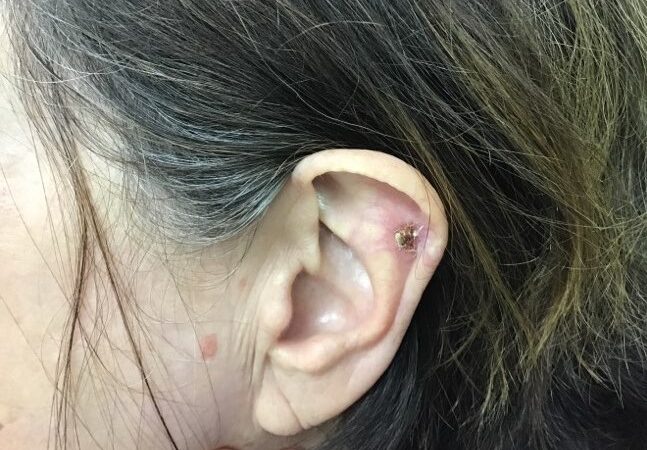 basal cell carcinoma on woman's ear