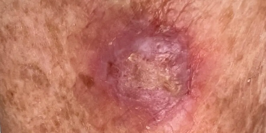A photo of a squamous cell carcinoma on a leg