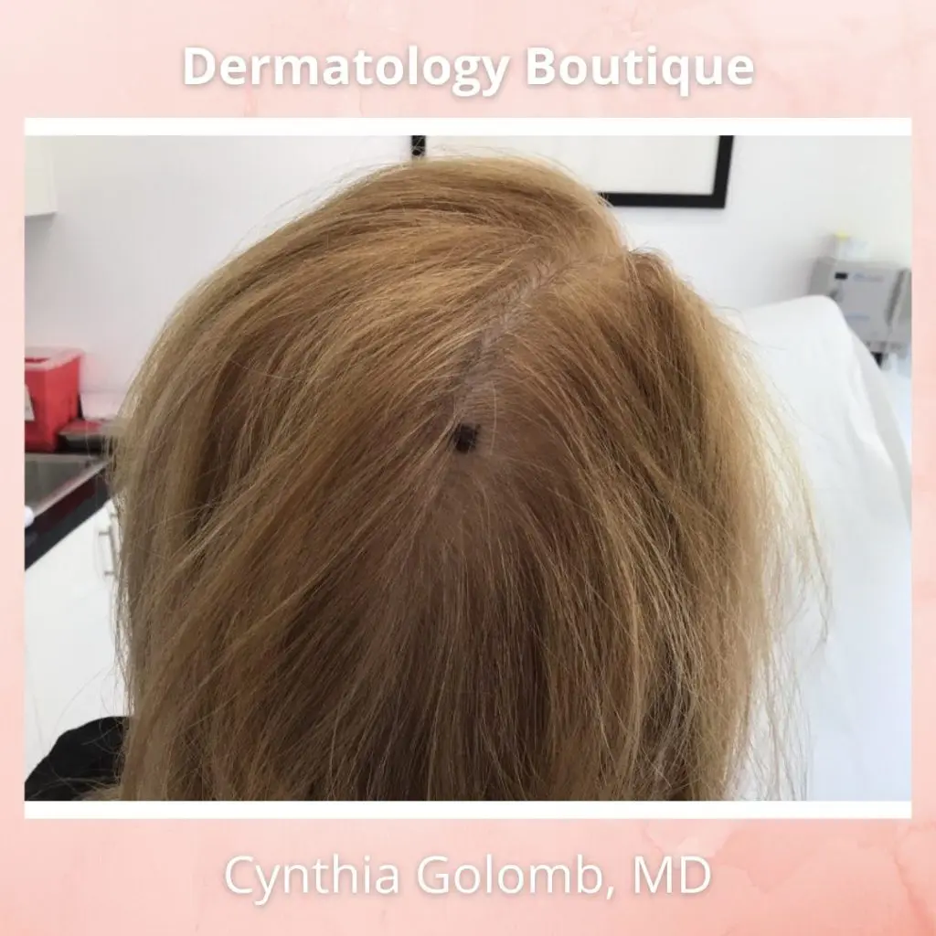 melanoma lesion on scalp