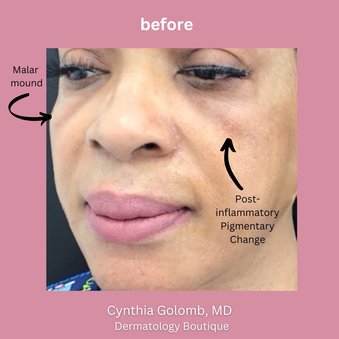 What are Malar Mounds and Festoons and How to Get Rid of Them Cynthia